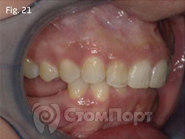 Ускоренная ортодонтия-21