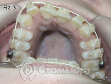 Ускоренная ортодонтия-3