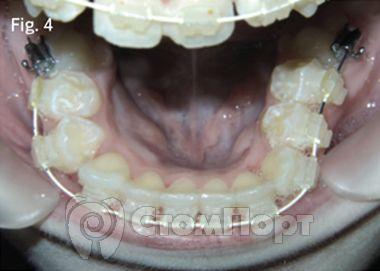 Ускоренная ортодонтия-4