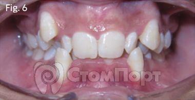 Ускоренная ортодонтия-6