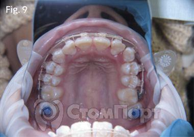 Ускоренная ортодонтия-9
