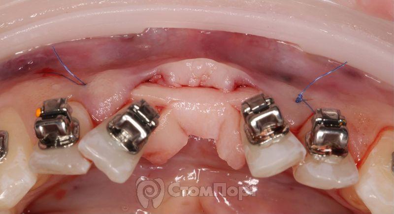 Устранение рецессии десны перед ортодонтическим лечением-2
