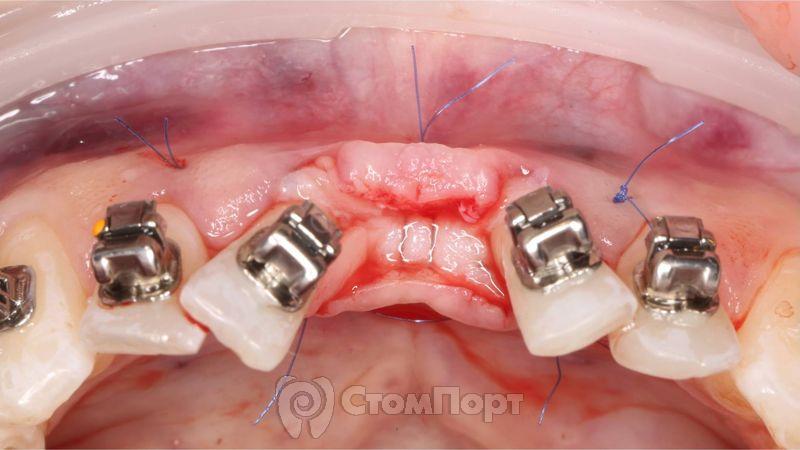 Устранение рецессии десны перед ортодонтическим лечением-3
