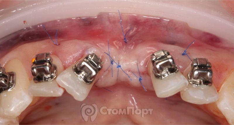 Устранение рецессии десны перед ортодонтическим лечением-4