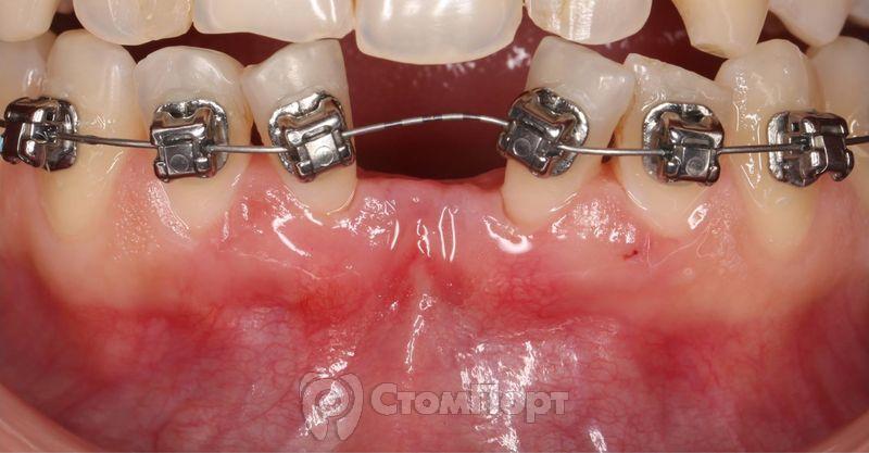 Устранение рецессии десны перед ортодонтическим лечением-5