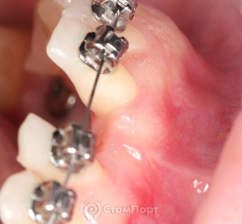 Устранение рецессии десны перед ортодонтическим лечением-6