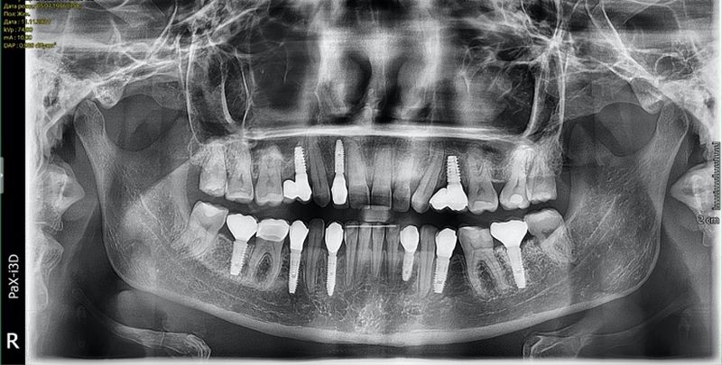 Рисунок 15 - Панорамный рентгеновский снимок после лечения