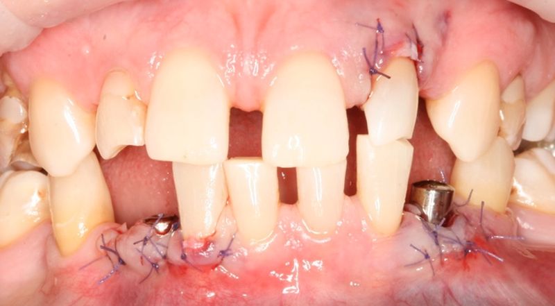 Рисунок 4 - Установлены имплантаты и формирователи десны в позиции 13 и 23 (OneQ-SL от Dentis)