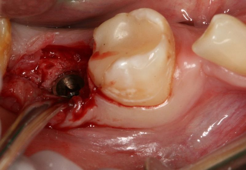 Рисунок 6 - Удаление 47 зуба вследствие обострения периодонтита