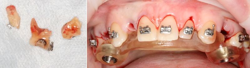 Рисунок 8 - Удалённые молочные зубы с верхней челюсти. 3D шаблон зафиксирован на зубах